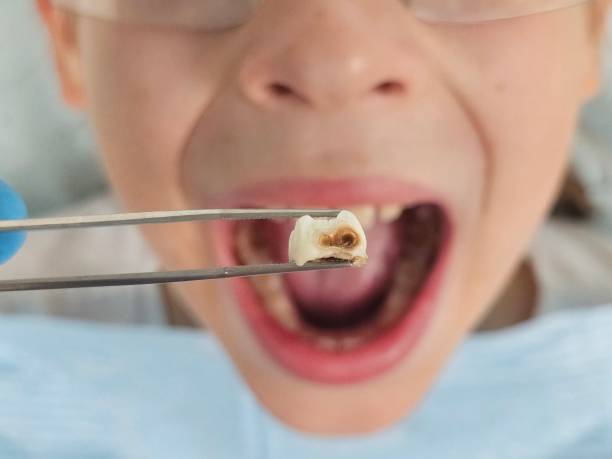 Best Emergency Care for Gum Disease in Carthage, MS