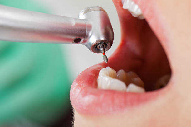 Best Emergency Cosmetic Dentistry (e.g., broken veneers) in Carthage, MS